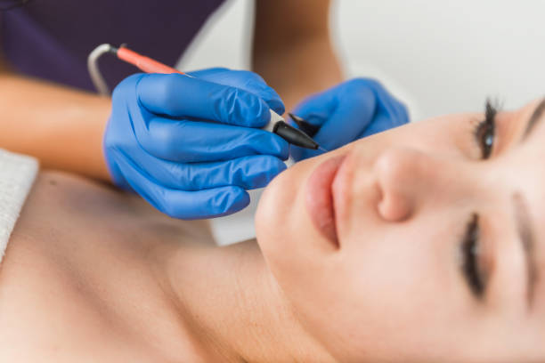 Dermatologist doing hair removal treatment on patient’s face with electrolysis Dermatologist doing hair removal treatment on patient's face with electrolysis